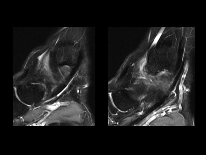 Figure 2 for case anteromedial ankle impingement